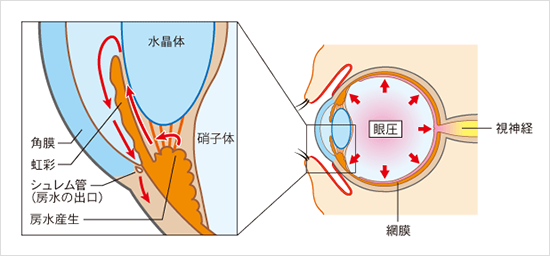 続発緑内障